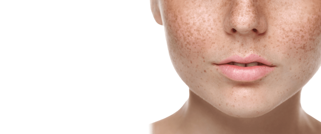 Freckles and Brown Spot treatments Bondi Junction Cosmetic Clinic