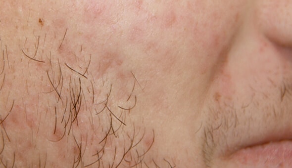 close up of cheek with acne after acnelan treatment