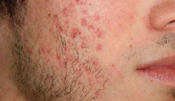 close up of cheek with acne before acnelan treatment