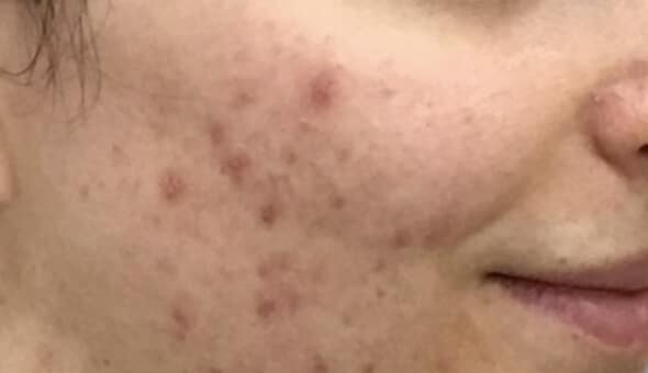 close up of cheek with acne before acnelan treatment