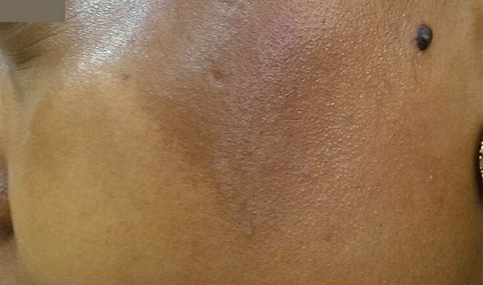 Close up photo of upper cheek with melasma before dermamelan peel