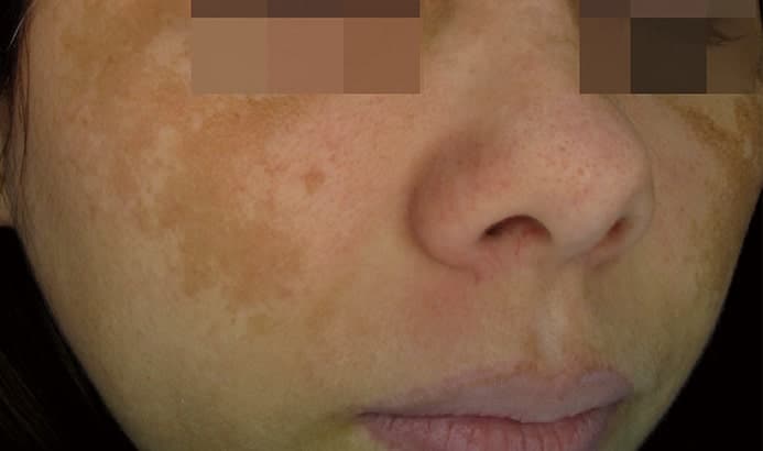 Close up photo of lower face with melasma before dermamelan peel