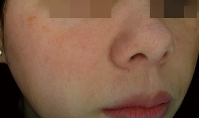Close up photo of lower face with melasma after dermamelan peel
