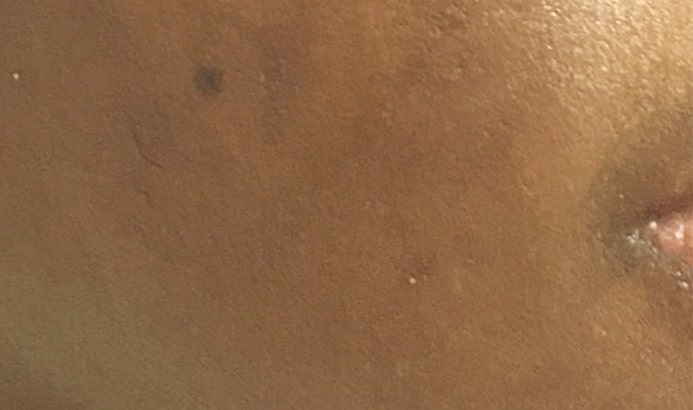 Close up photo of cheek with melasma pigmentation before dermamelan peel