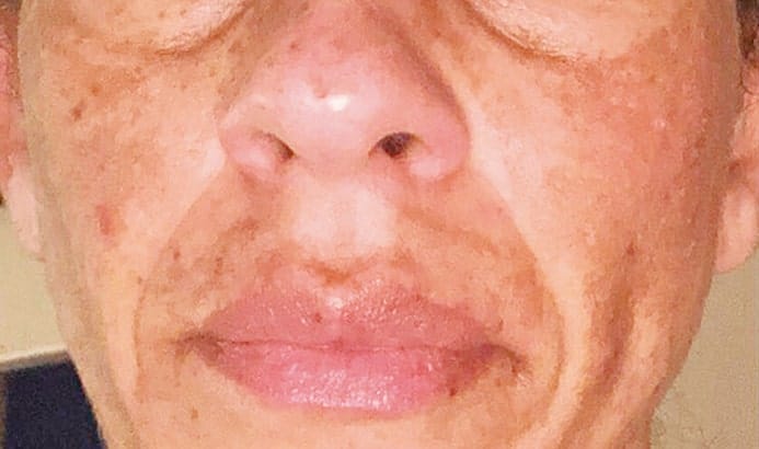 close up photo of face below eyes with melasma pigmentation before dermemelan treatment