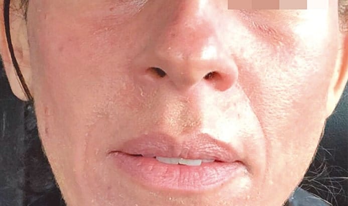 close up photo of face below eyes with melasma pigmentation after dermemelan treatment