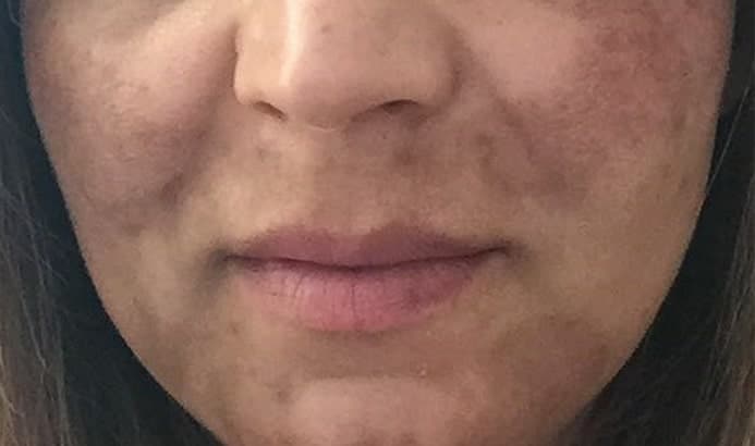 close up photo of lower two thirds of face with melasma pigmentation before dermemelan treatment