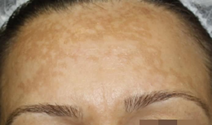 close up photo of forehead with melasma pigmentation before dermemelan treatment