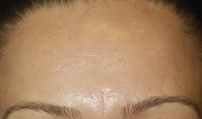 close up photo of forehead with melasma pigmentation after dermemelan treatment