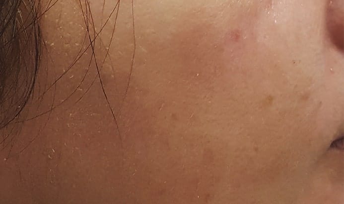 Close up photo of cheek with melasma pigmentation after dermamelan peel