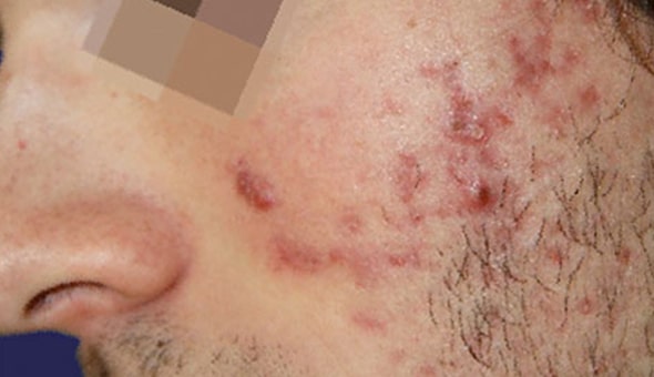 close-up-photo-of-LHS-cheek-acnelan-treatment-before-1