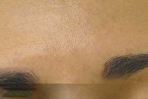 close up of forehead with brown spots after hydrafacial treatment