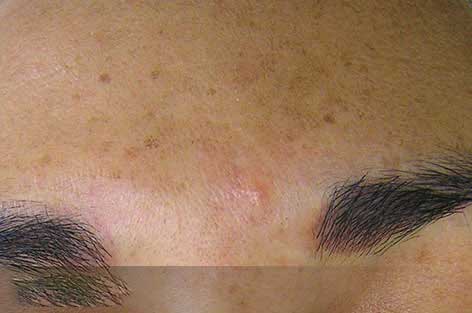 close up of forehead with brown spots before hydrafacial treatment