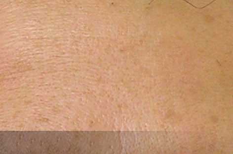close up of forehead with lines and wrinkles after hydrafacial treatment