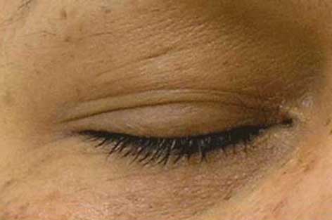 hydrafacial-before-after-Undereye-Puffiness-after-updated