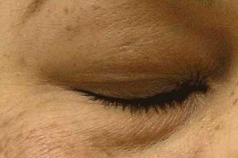 close up of under eye area before hydrafacial treatment