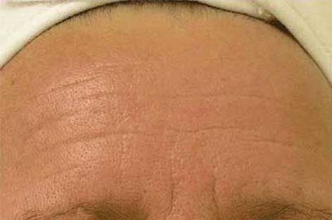 close up of forehead with lines and wrinkles after hydrafacial treatment