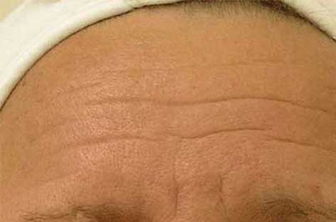 close up of forehead with lines and wrinkles before hydrafacial treatment