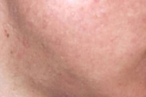 close up of cheek with acne after 4 treatments with dual yellow laser