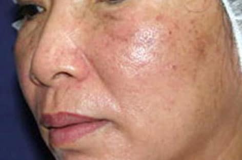 close up of left cheek after 1 treatment for skin rejuvenation with dual yellow laser