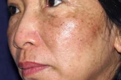 close up of left cheek before skin rejuvenation with dual yellow laser