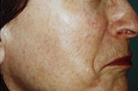 close up on right cheek after 1 treatment for skin rejuvenation with dual yellow laser