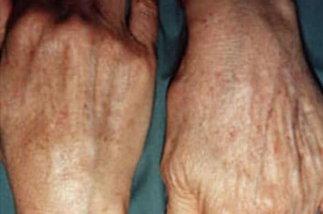 close up of hands with solar lentigines after 1 treatment with dual yellow laser