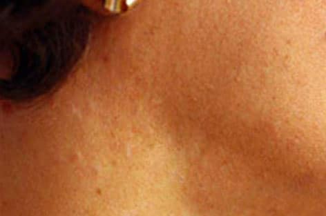 close up of temple sebhorrhoeic keratosis after 1 treatment with dual yellow laser