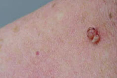 close up of skin tag before 1 treatment with dual yellow laser