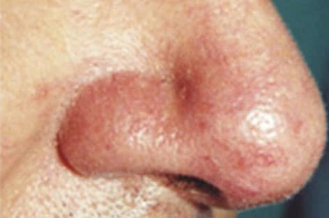 close up of nose with visible capillaries after dual yellow laser