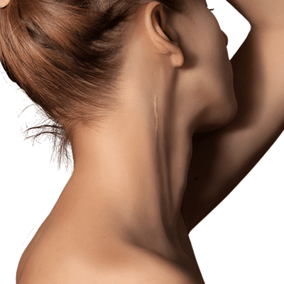 Scar Treatment cosmetic treatments sydney