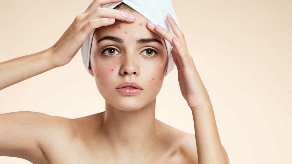 Let’s tackle acne and acne scarring