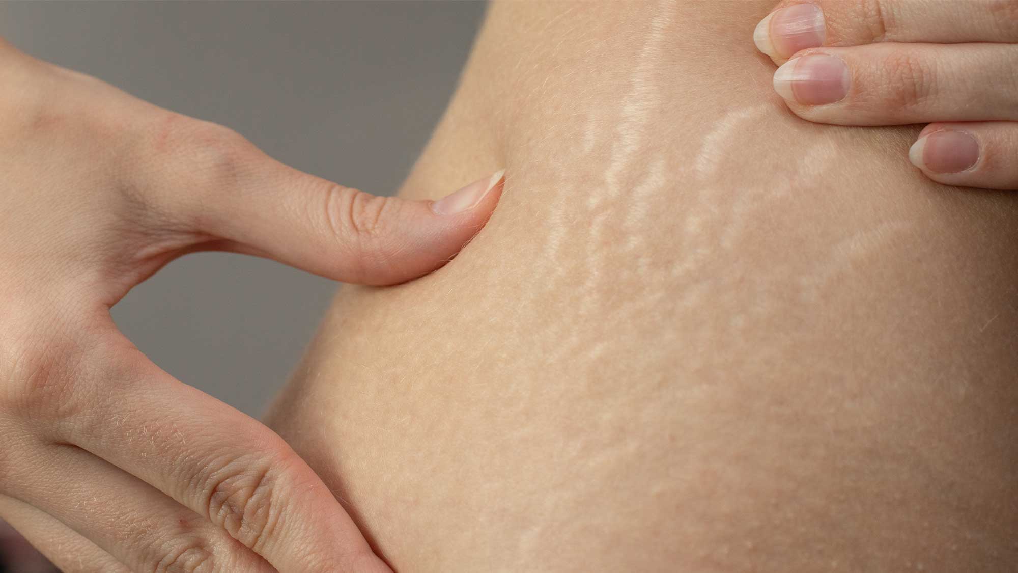 How to treat stretchmarks - motherhood’s badge of honour