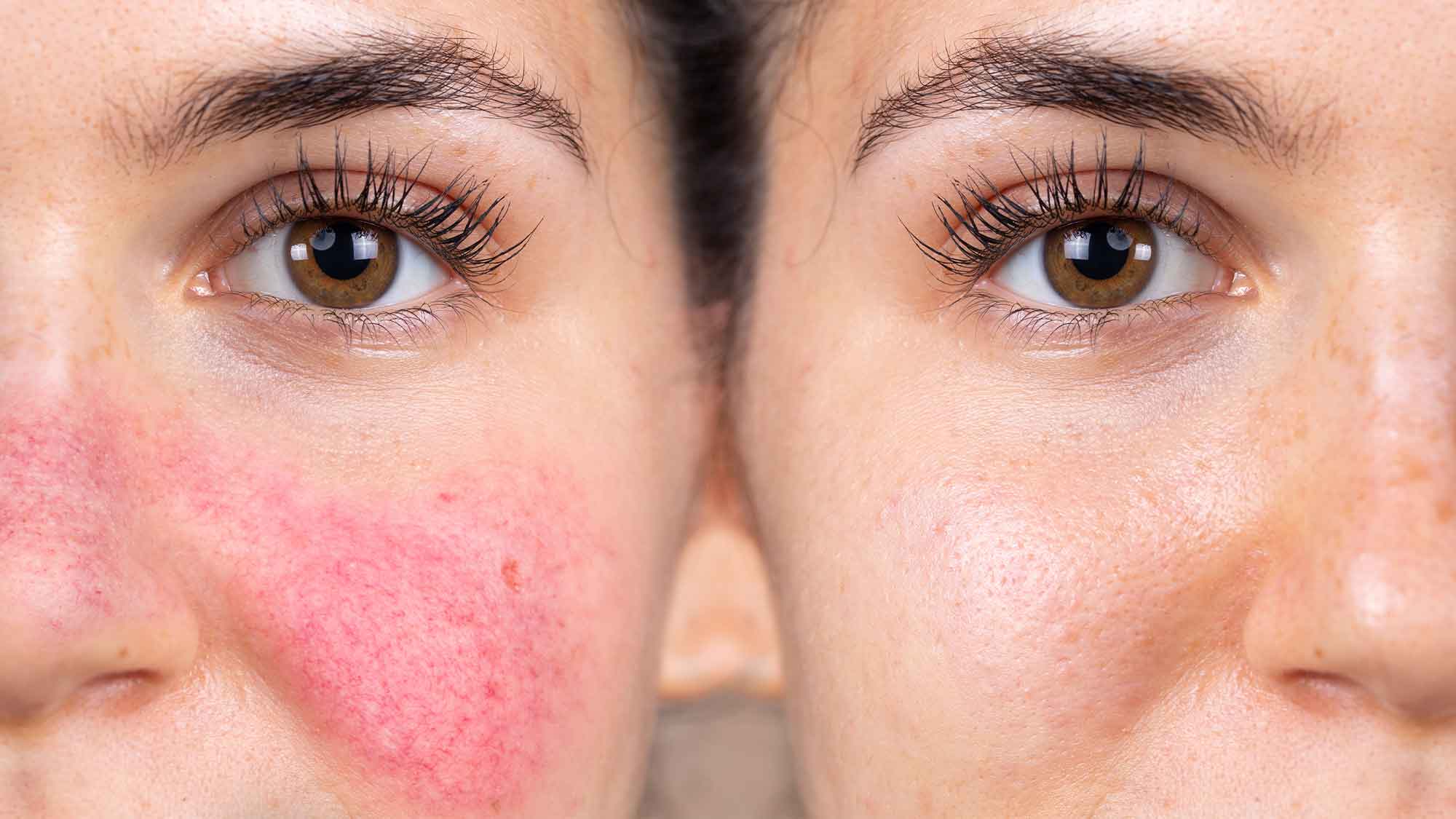 The challenge with treating Rosacea