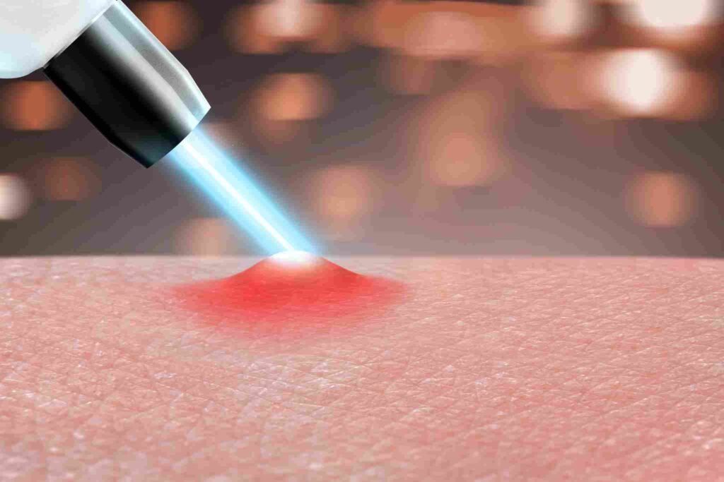 laser for acne and acne scars