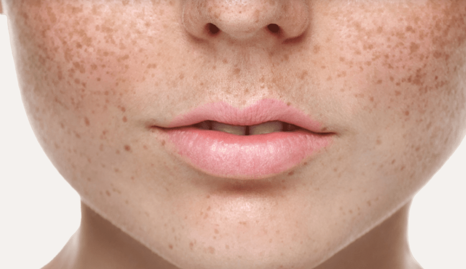 Freckles cosmetic clinic