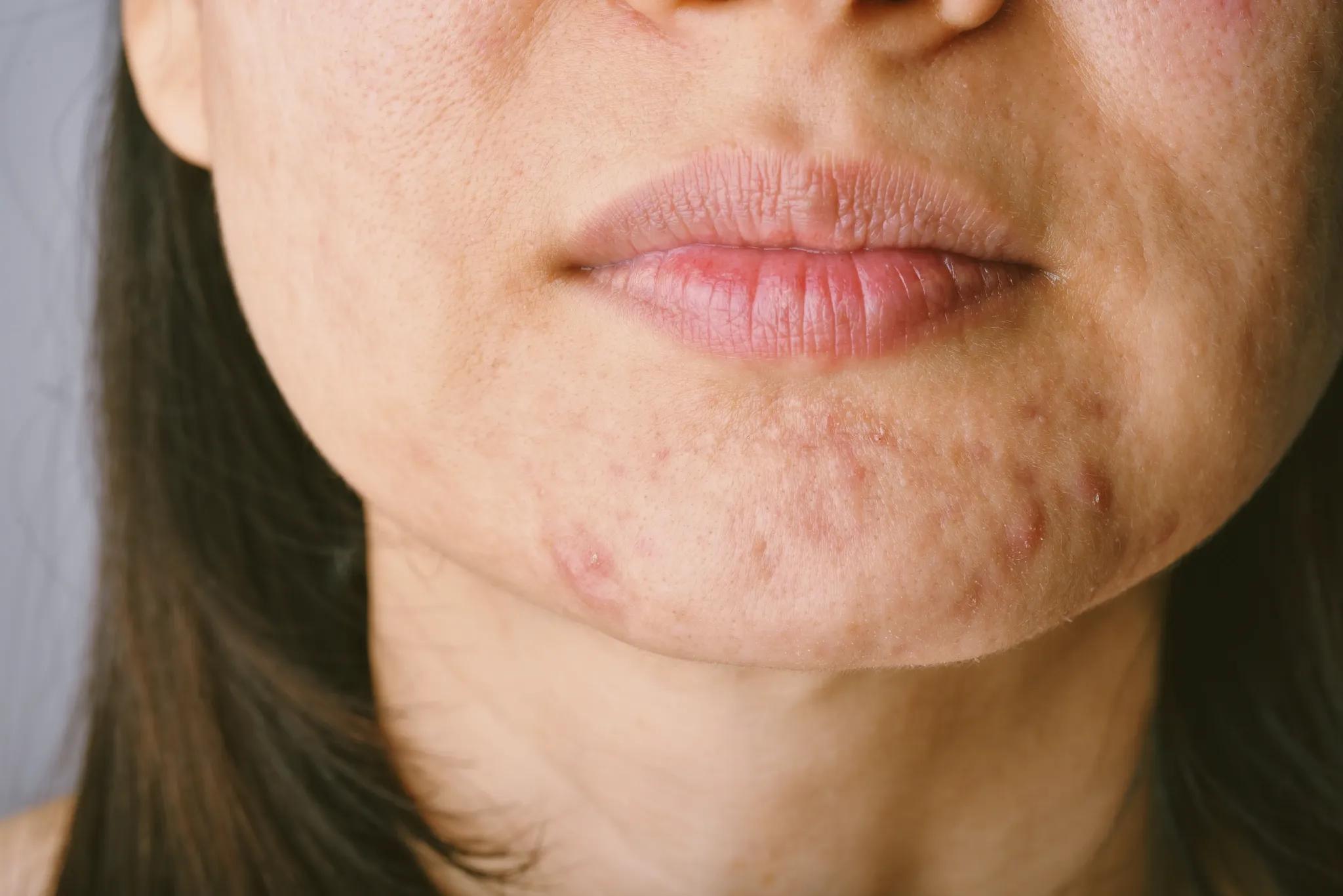 lady having chin breakout